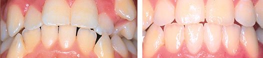 Orthodontic treatment before and after