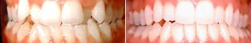 Orthodontic assessment of crowded teeth